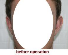 plastic-surgery-prominent-ear 